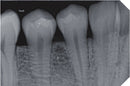 Intraoral Røntgen Sensor