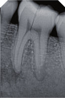 Intraoral Røntgen Sensor