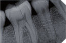 Intraoral Røntgen Sensor